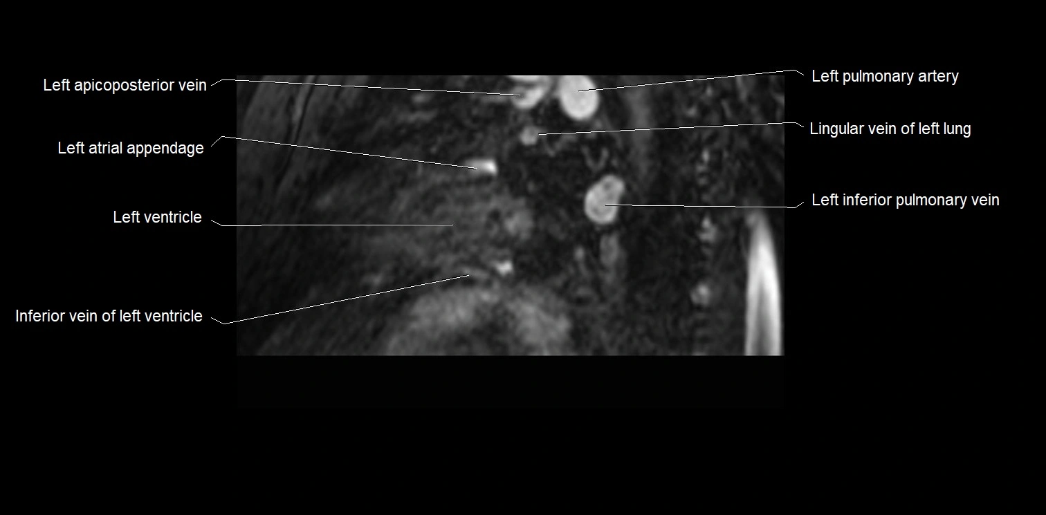 MRI heart and coronary arteries two chamber(sagittal)  anatomy image 37.webp